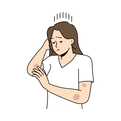 Hämatom, Bluterguss, Prellung