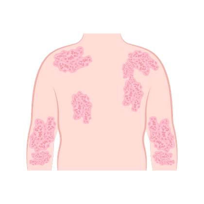 Atopische Dermatitis, Neurodermitis