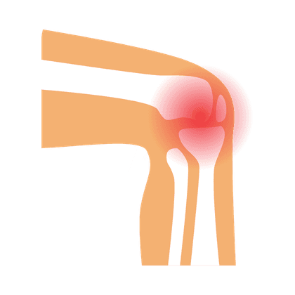 Rheumatoide Arthritis