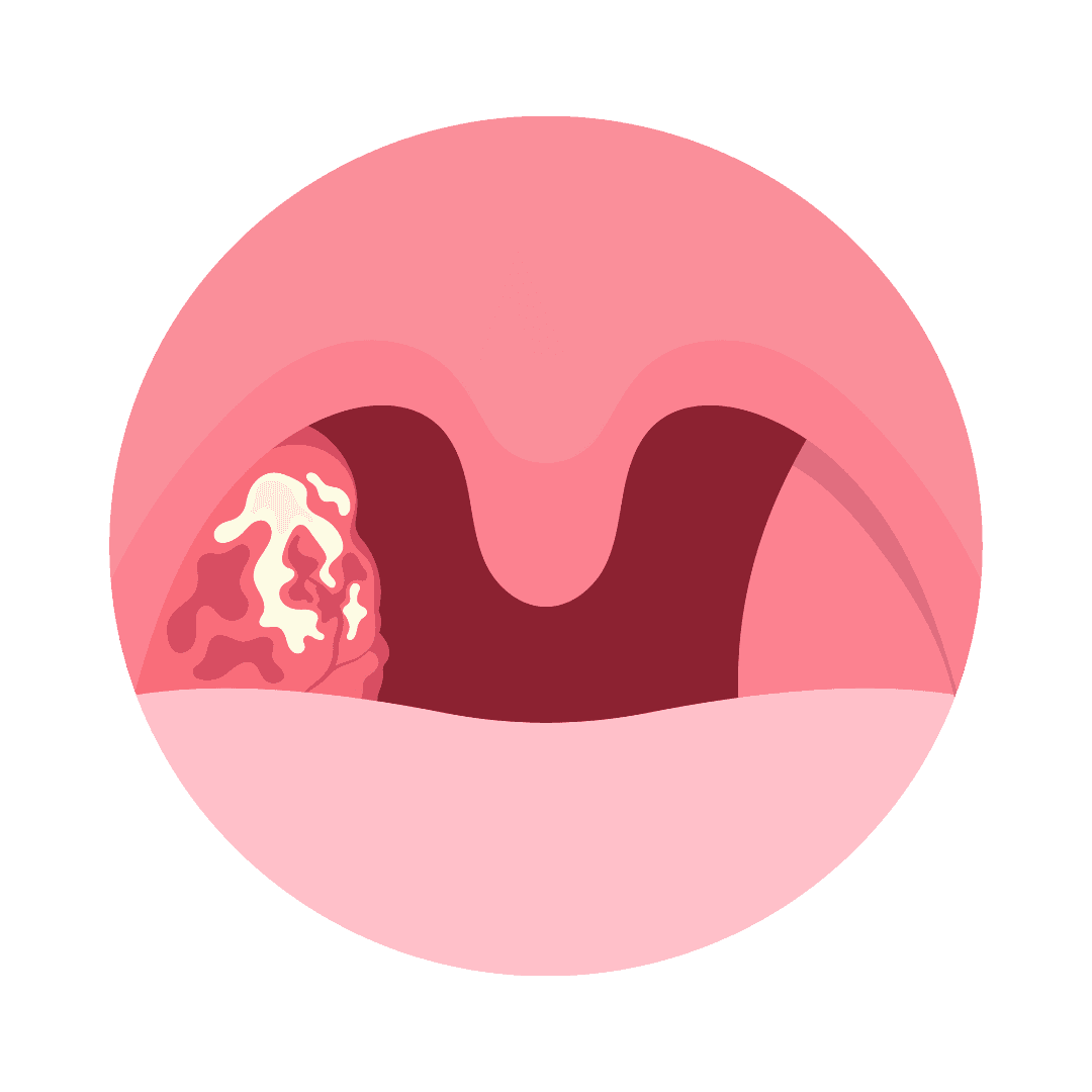 Adenoide bei Kindern