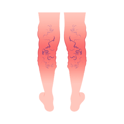 Krampfadern (Varizen)