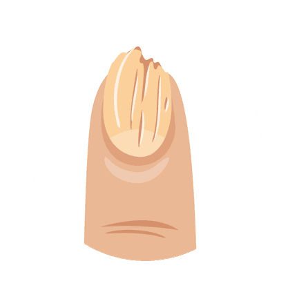 Onycholyse (Nagelplattenablösung)