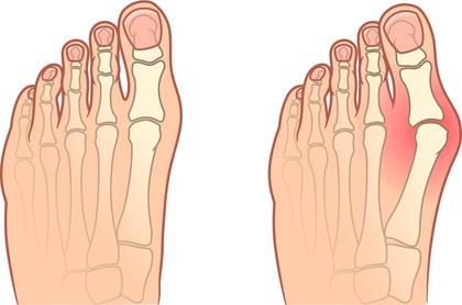 Hallux valgus (Ballenzeh)
